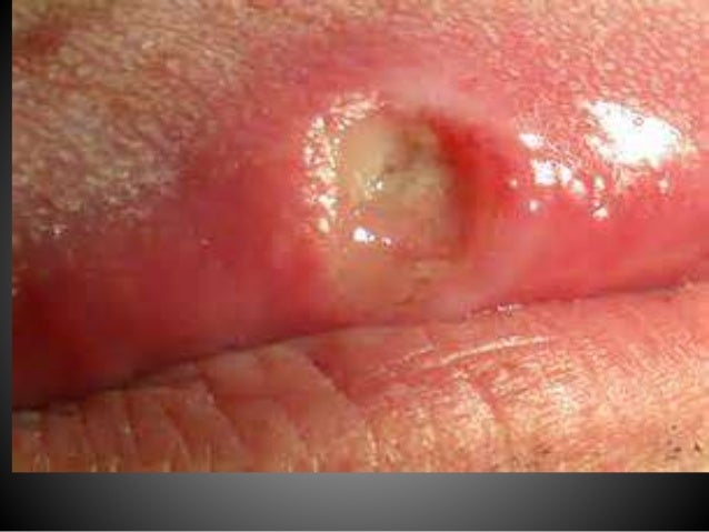 white ulcer penis White ulcer penis